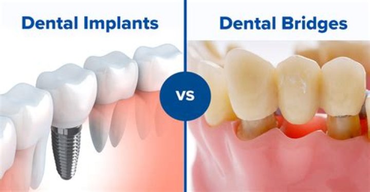 Are bridges better than implants?