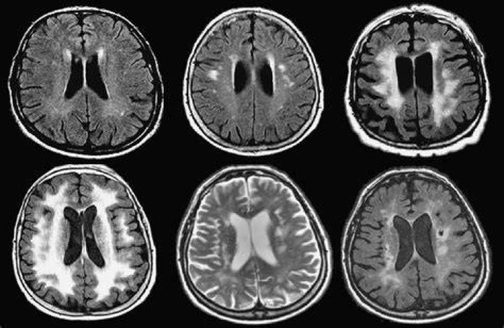 Can MRI detect dementia?