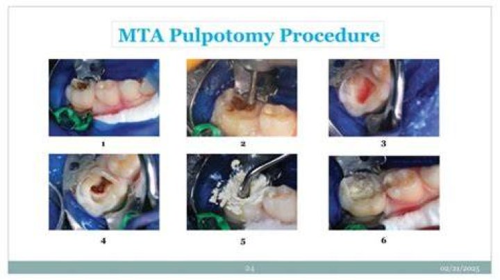 Can MTA be used in primary teeth?