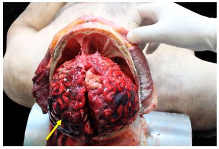 Discoveries From Tarrare Autopsy Images