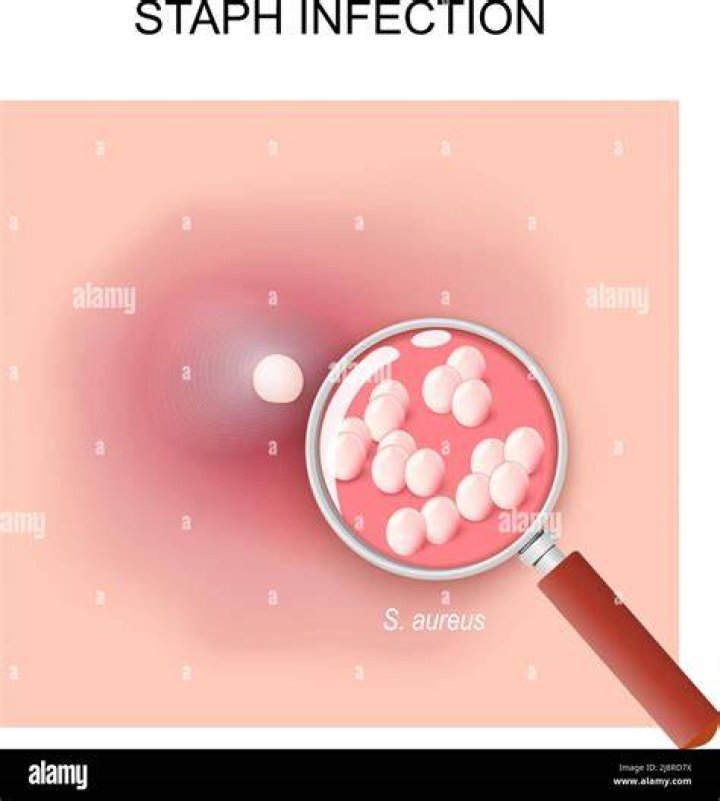 Does Staph look like a pimple?