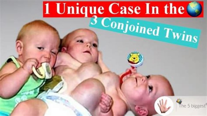 Has there ever been conjoined triplets?