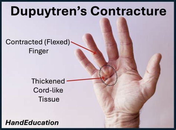 How fast does Dupuytren's progress?