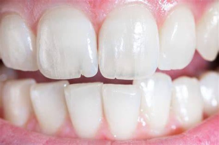 What happens if veneers are not replaced?