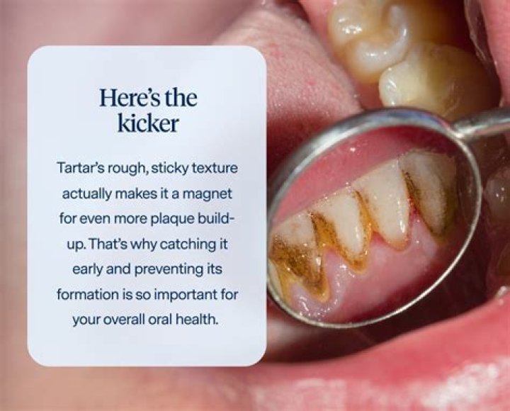 Why do I have so much tartar buildup?